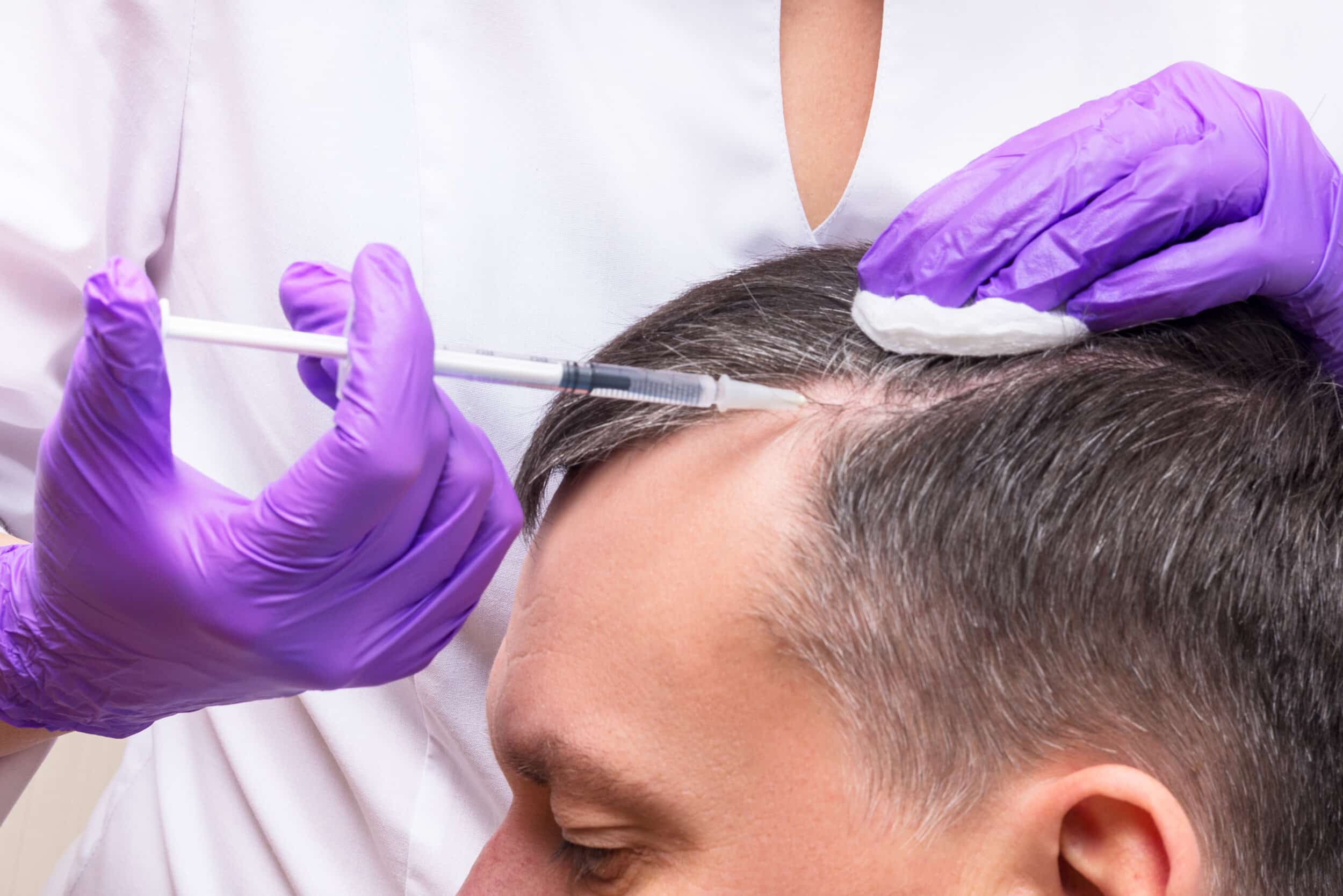PRF Injections for Hair Loss