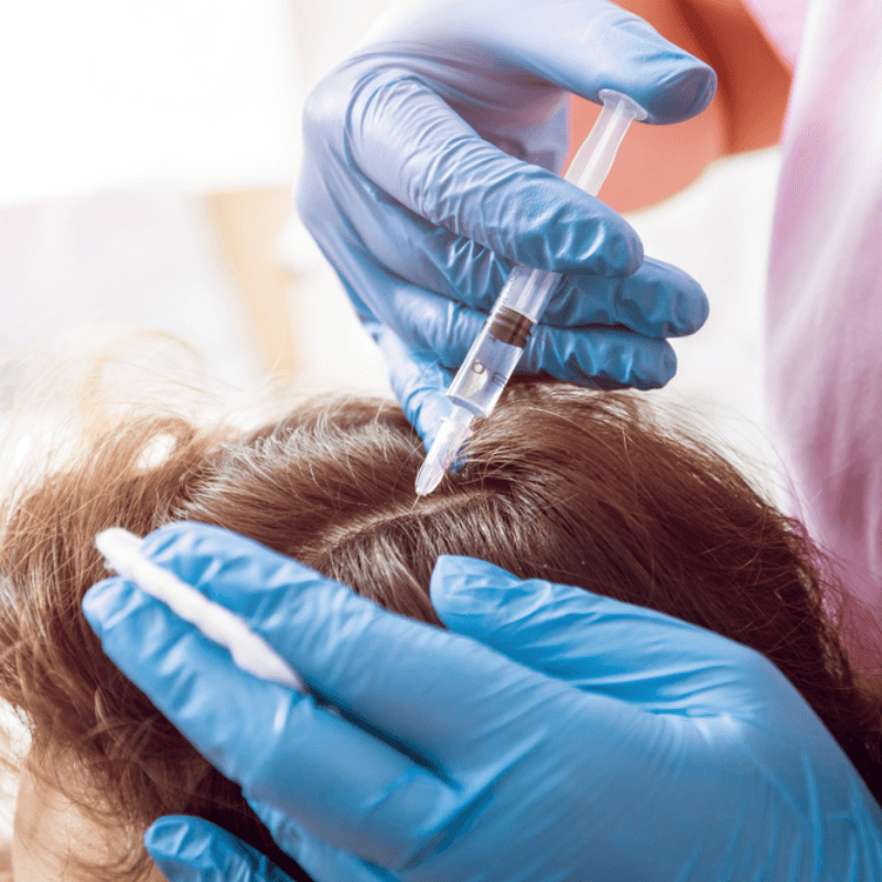 PRF Injections for Hair Loss