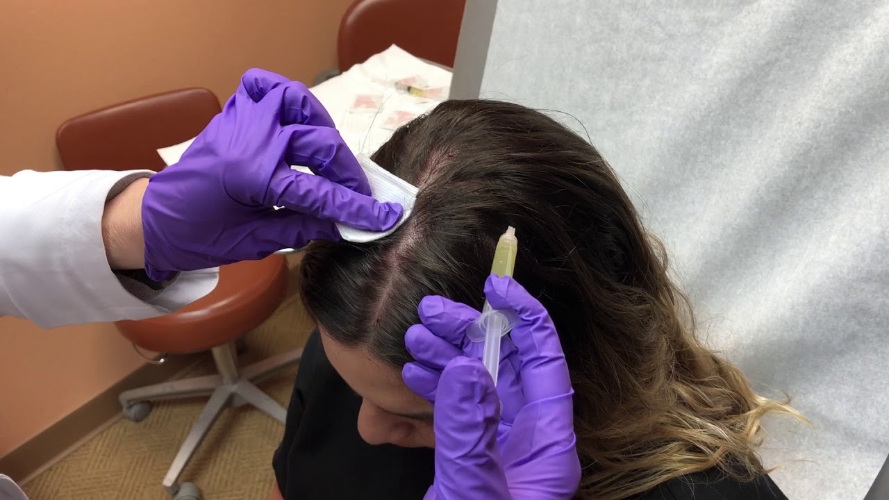 Hair Loss Treatment.
