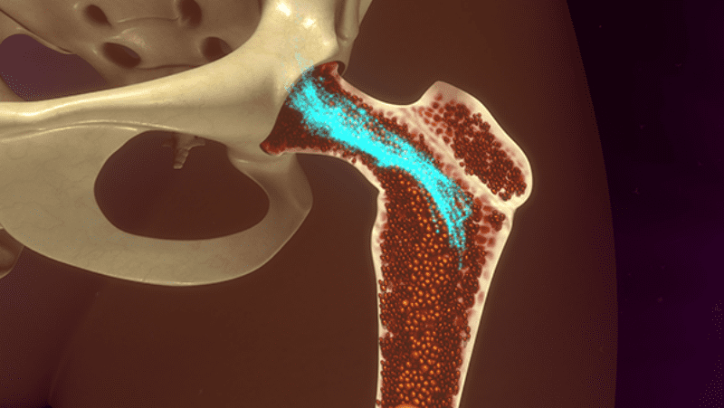 Bone Marrow Aspirate Concentrate Treatments