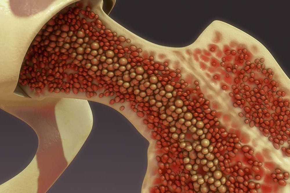 Bone Marrow Aspirate Concentrate 