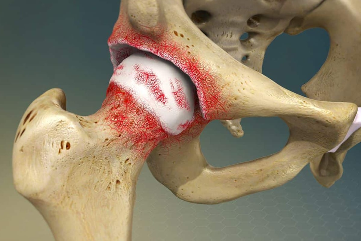 Osteoarthritis Treatment