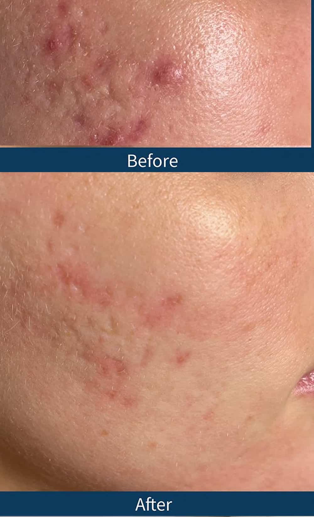 Exosome Therapy Before and After