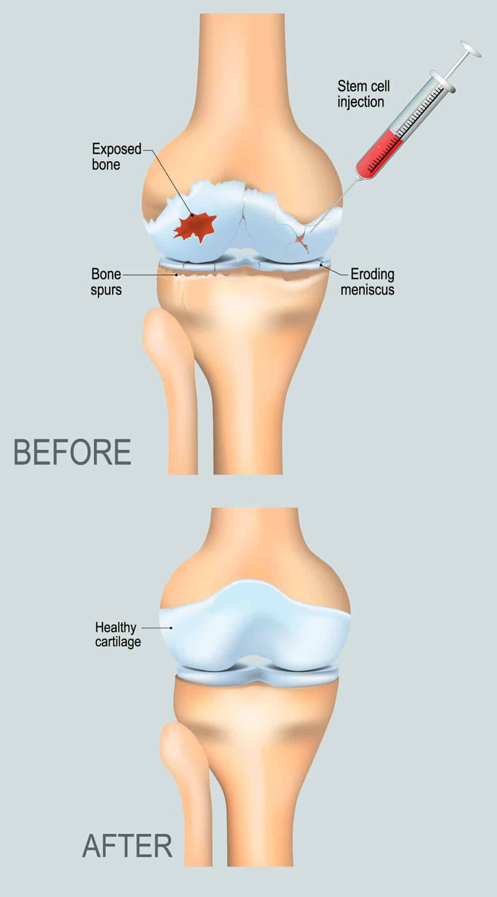 : Stem Cell Injections Before and After