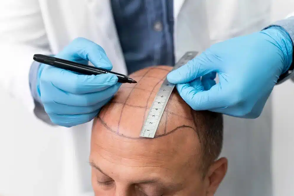 Hair Restoration In Orlando 