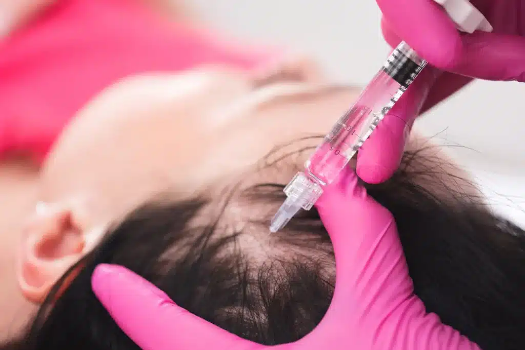 PRF Injections for Hair Loss