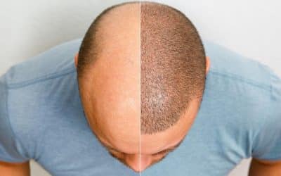 Hair Transplant Orlando