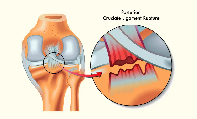 Ligament Injuries Winter Park